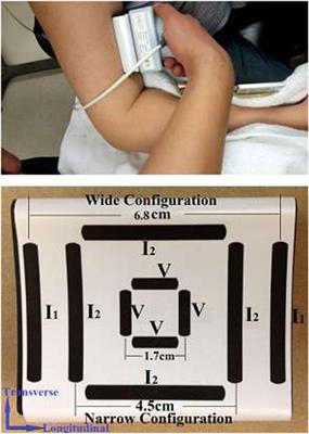 Alterations in Localized Electrical Impedance Myography of Biceps Brachii Muscles Paralyzed by Spinal Cord Injury